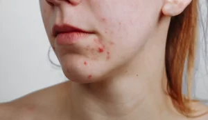 Disturbi della pelle: come curare acne e brufoli
